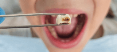 removed tooth being held